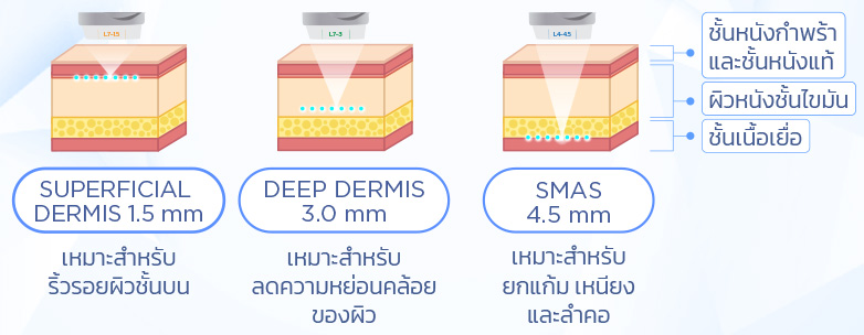 ระดับความลึกหัวยิง Ulthera