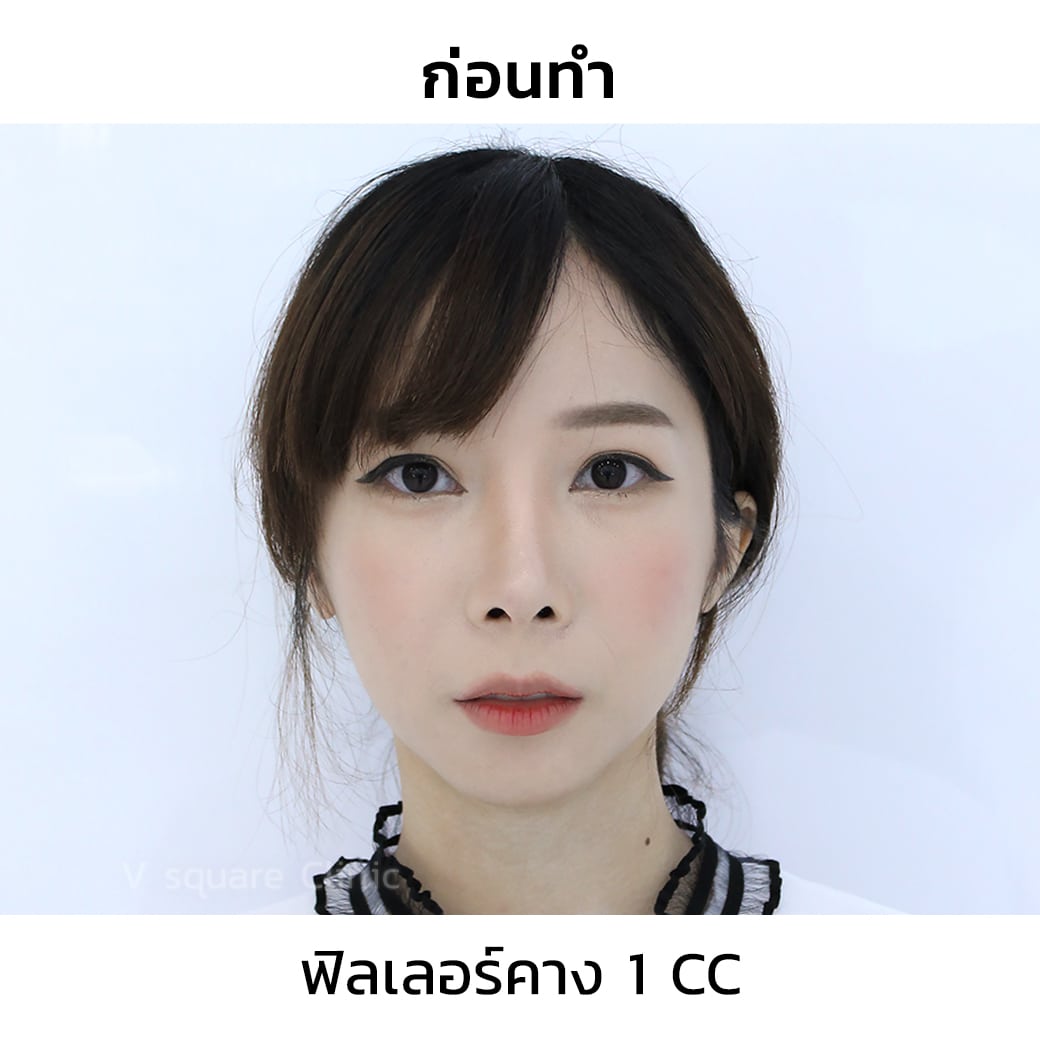 ฉีดฟิลเลอร์คาง 1 CC 01