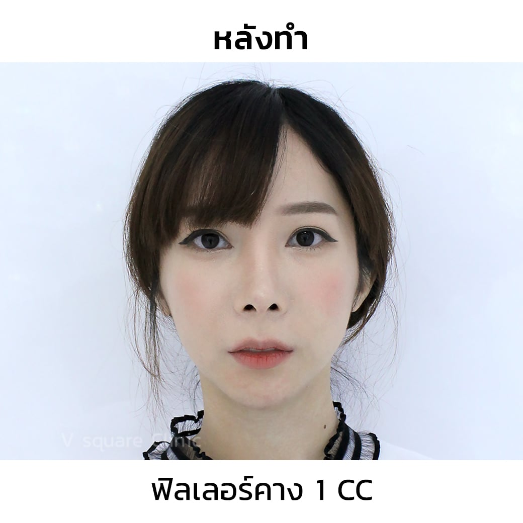 ฉีดฟิลเลอร์คาง 1 CC 02