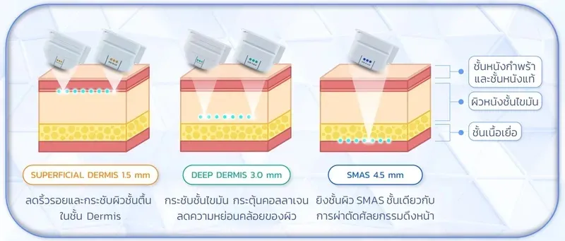 หัวยิง Ulthera
