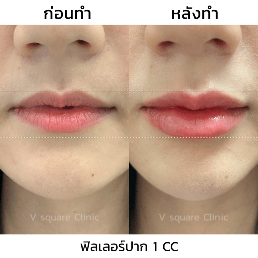 รีวิวฟิลเลอร์ปาก