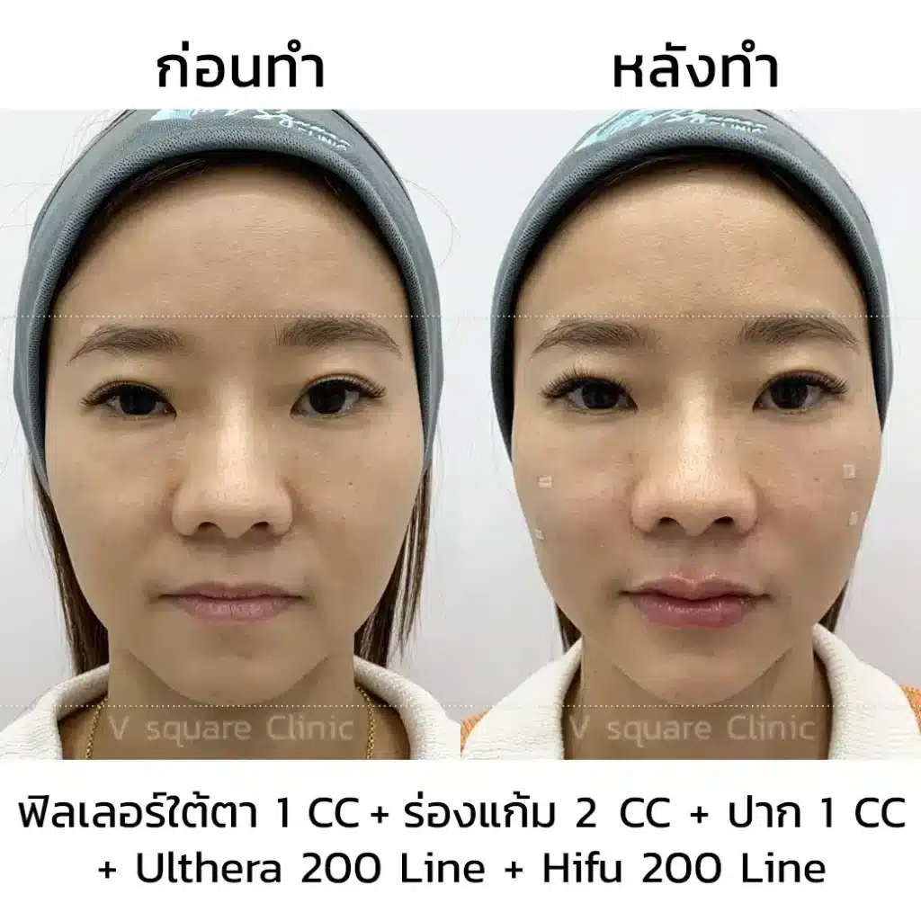 รีวิว Ulthera ยกกระชับใบหน้า 200 Line