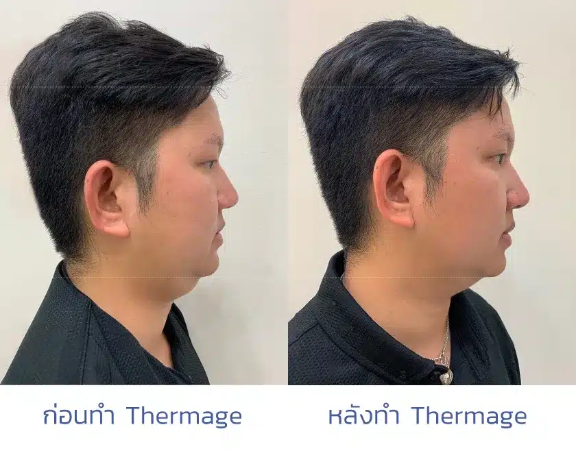 Thermage รีวิว 1