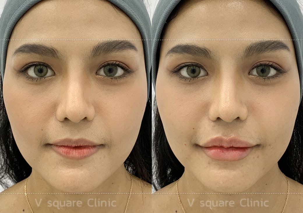 นพ.สิทธินันท์ มะโนปีน (หมอโต้ง) | V Square Clinic - V Square Clinic ...