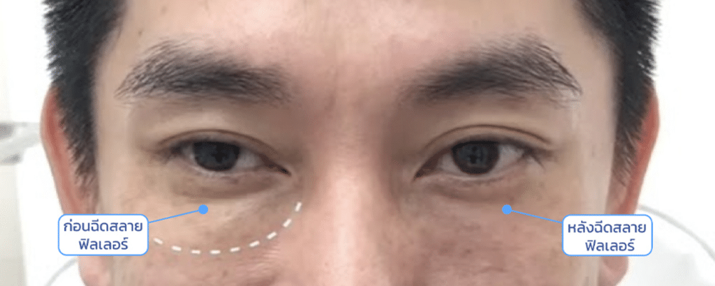 รีวิวฉีดสลายฟิลเลอร์ใต้ตา