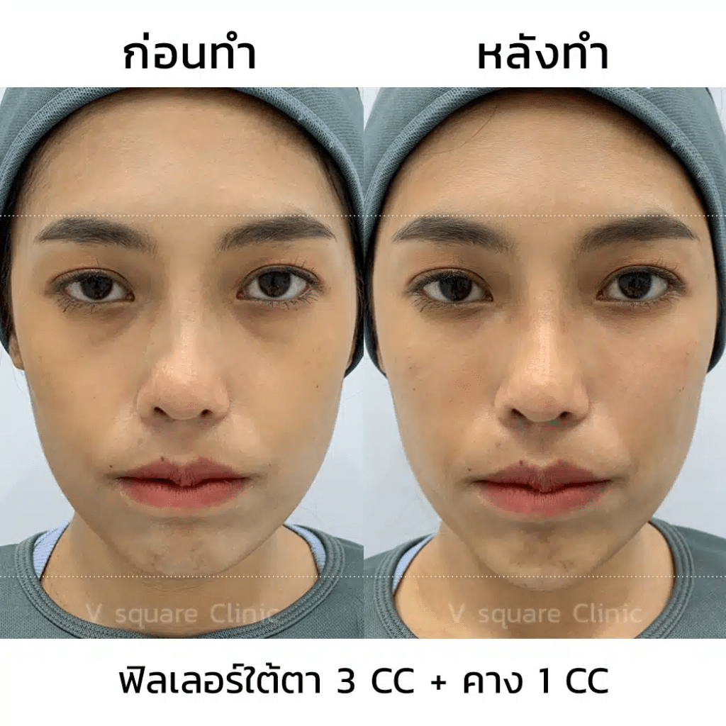 รีวิวฟิลเลอร์ใต้ตา