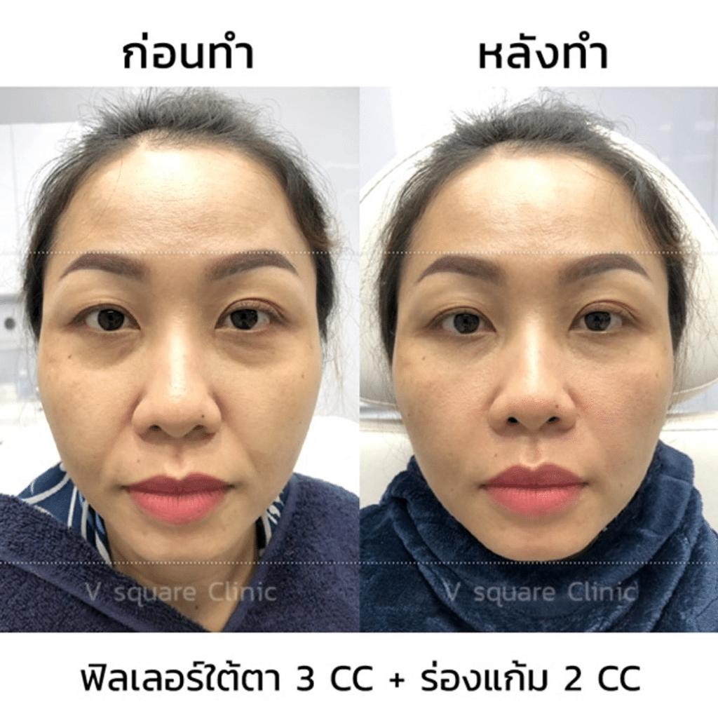 รีวิวฟิลเลอร์ใต้ตา(1)