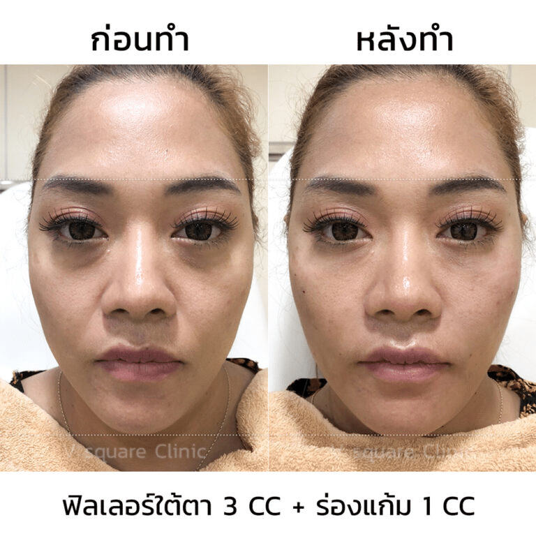 รีวิวฟิลเลอร์ใต้ตา(2)