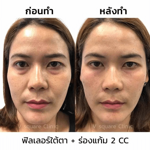 รีวิวฟิลเลอร์ใต้ตา(3)