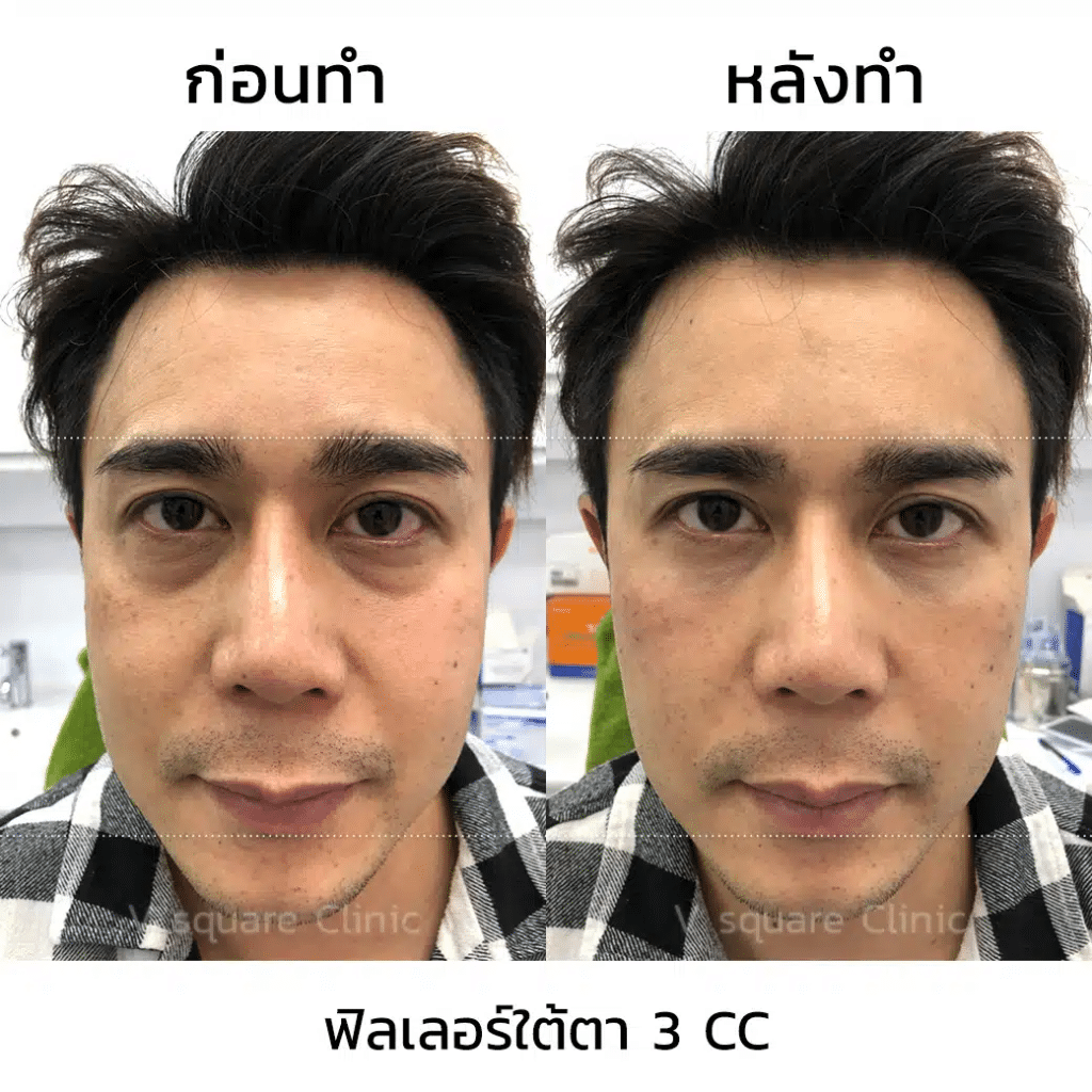 รีวิวฟิลเลอร์ใต้ตา(4)