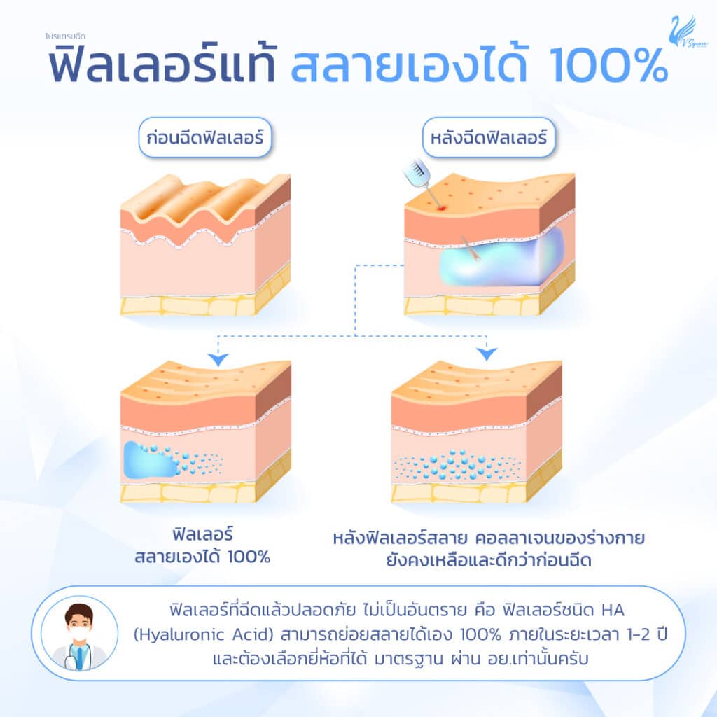 ฟิลเลอร์แท้