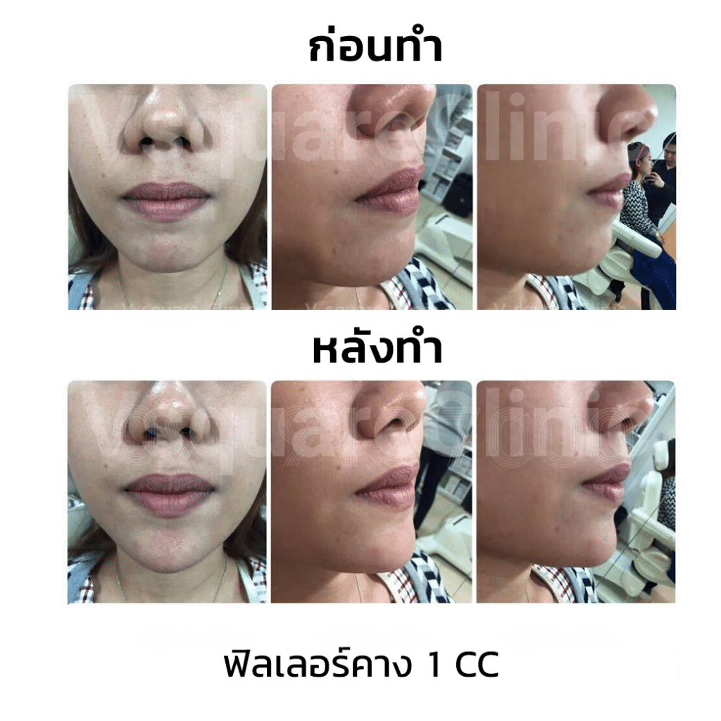 รีวิวฉีดฟิลเลอร์คาง