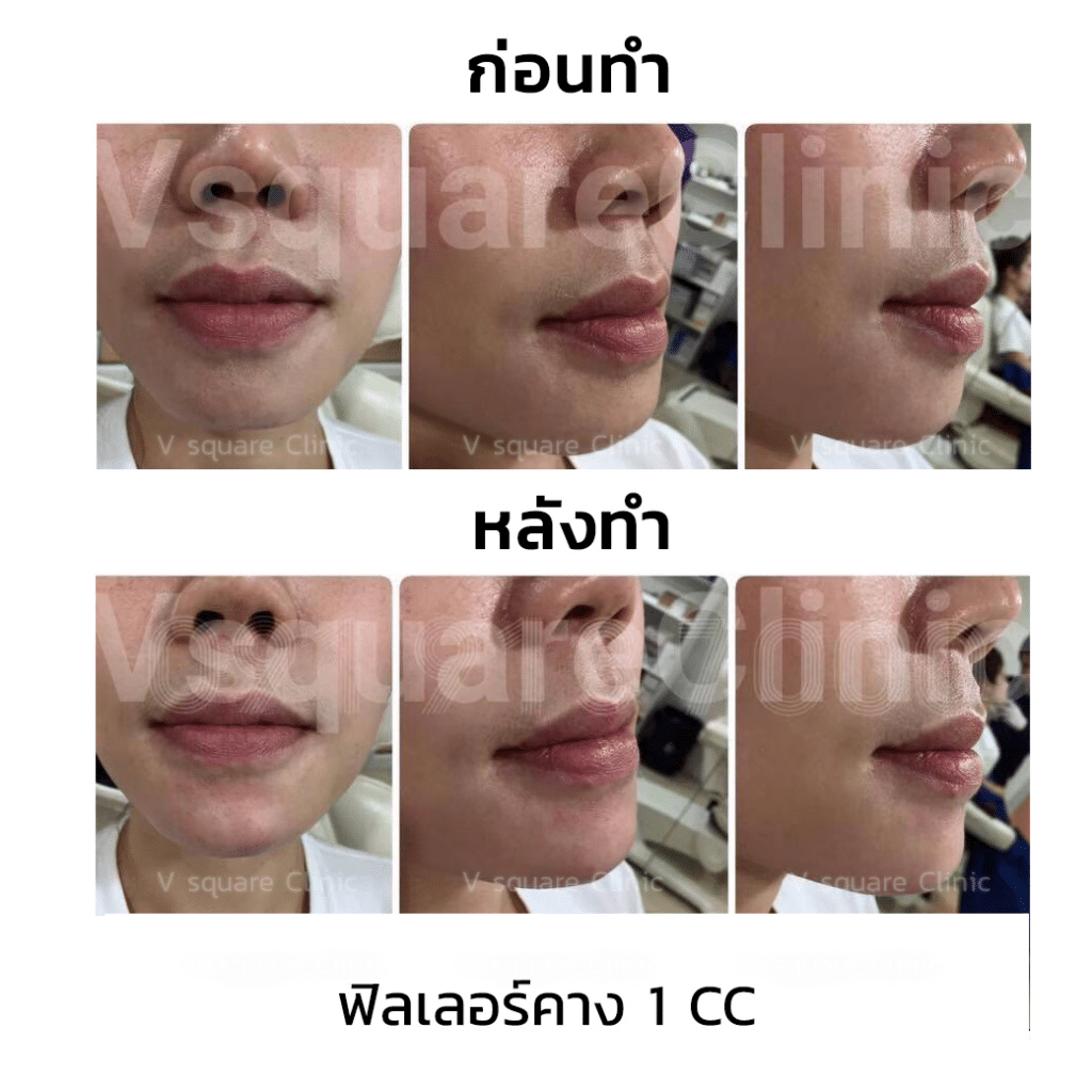 รีวิวฉีดฟิลเลอร์คาง(1)