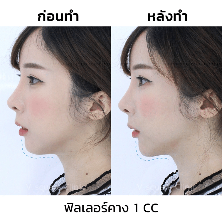 รีวิวฉีดฟิลเลอร์คาง(2)