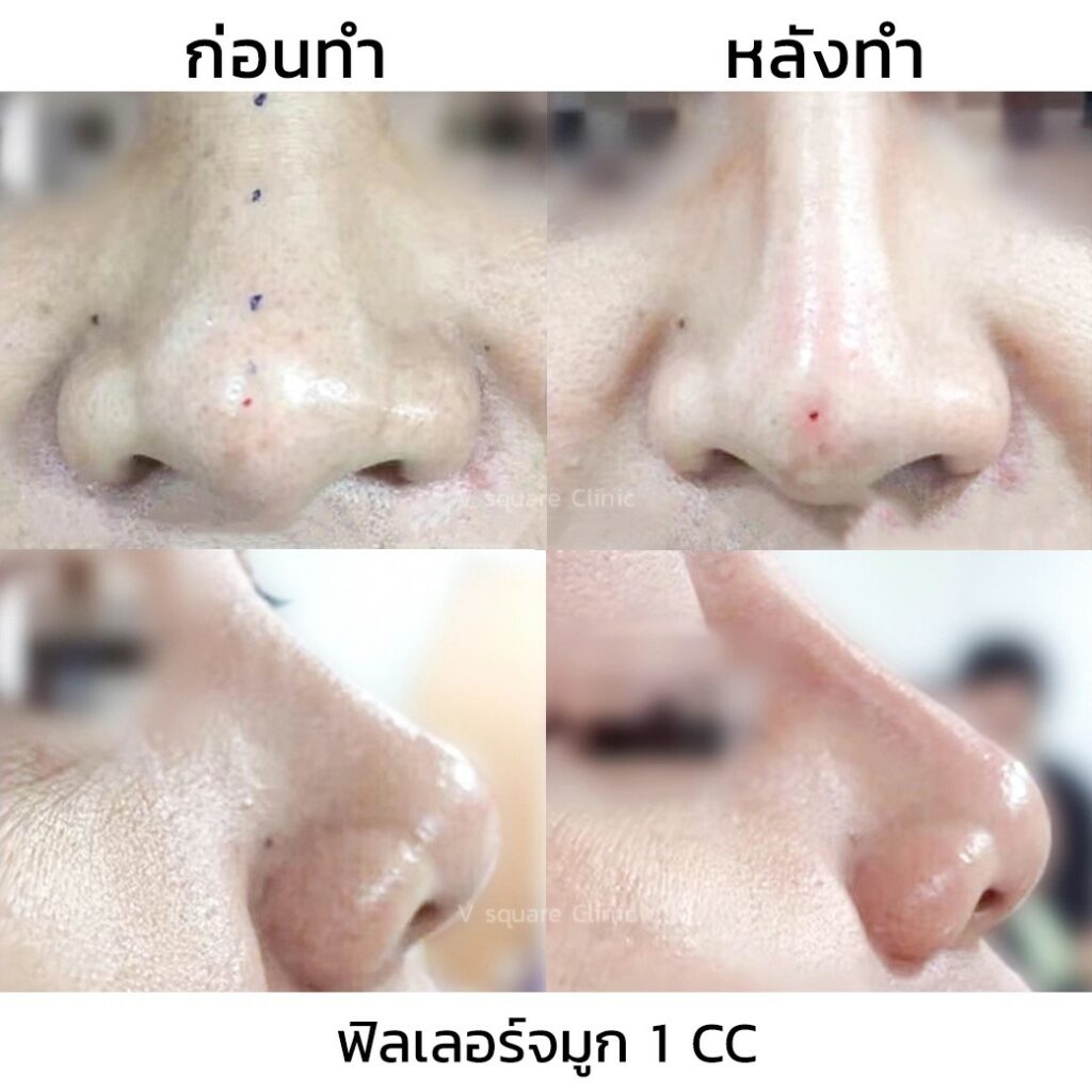 รีวิวฉีดฟิลเลอร์จมูก