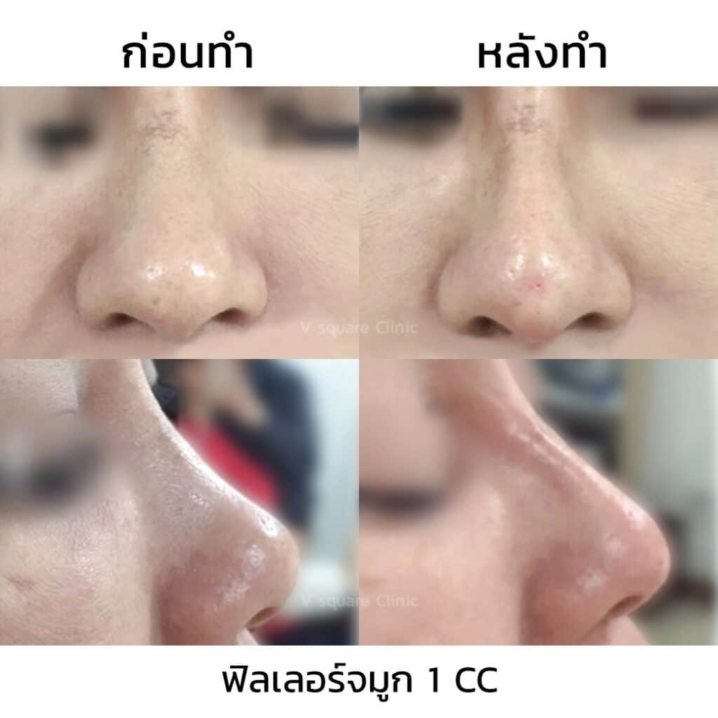 รีวิวฉีดฟิลเลอร์จมูก (1)