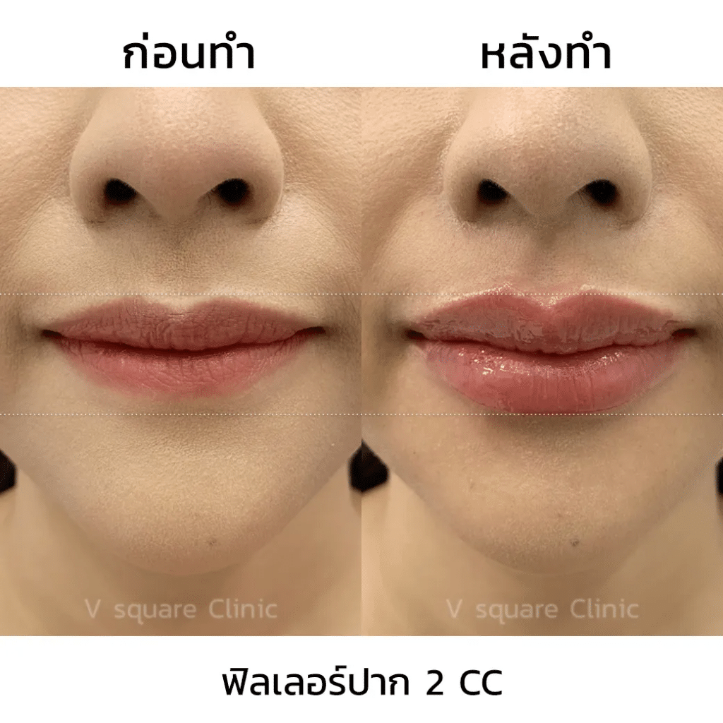 รีวิวฉีดฟิลเลอร์ปาก