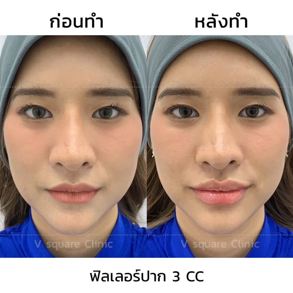 รีวิวฉีดฟิลเลอร์ปาก