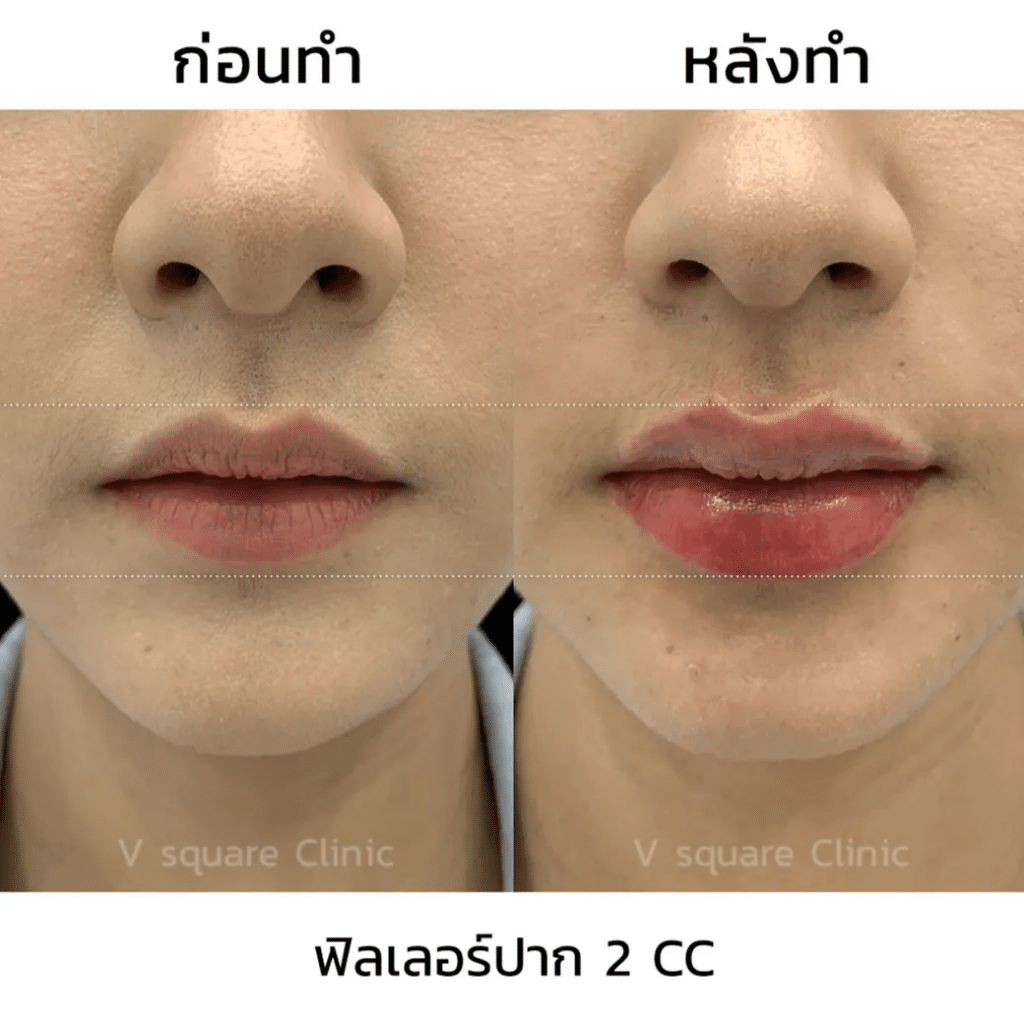 รีวิวฉีดฟิลเลอร์ปาก