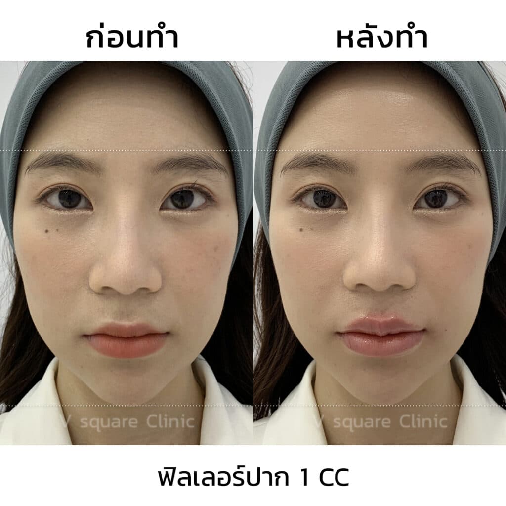 รีวิวฉีดฟิลเลอร์ปาก(1)