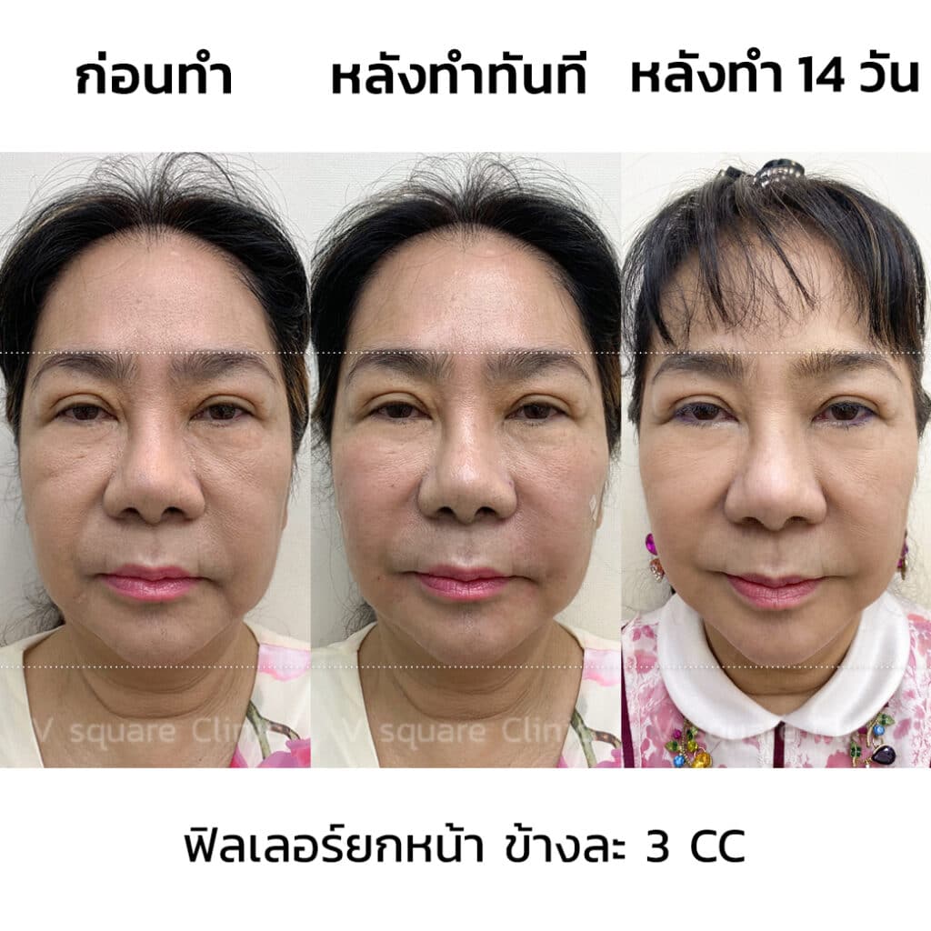 รีวิวฉีดฟิลเลอร์ยกหน้า(4)