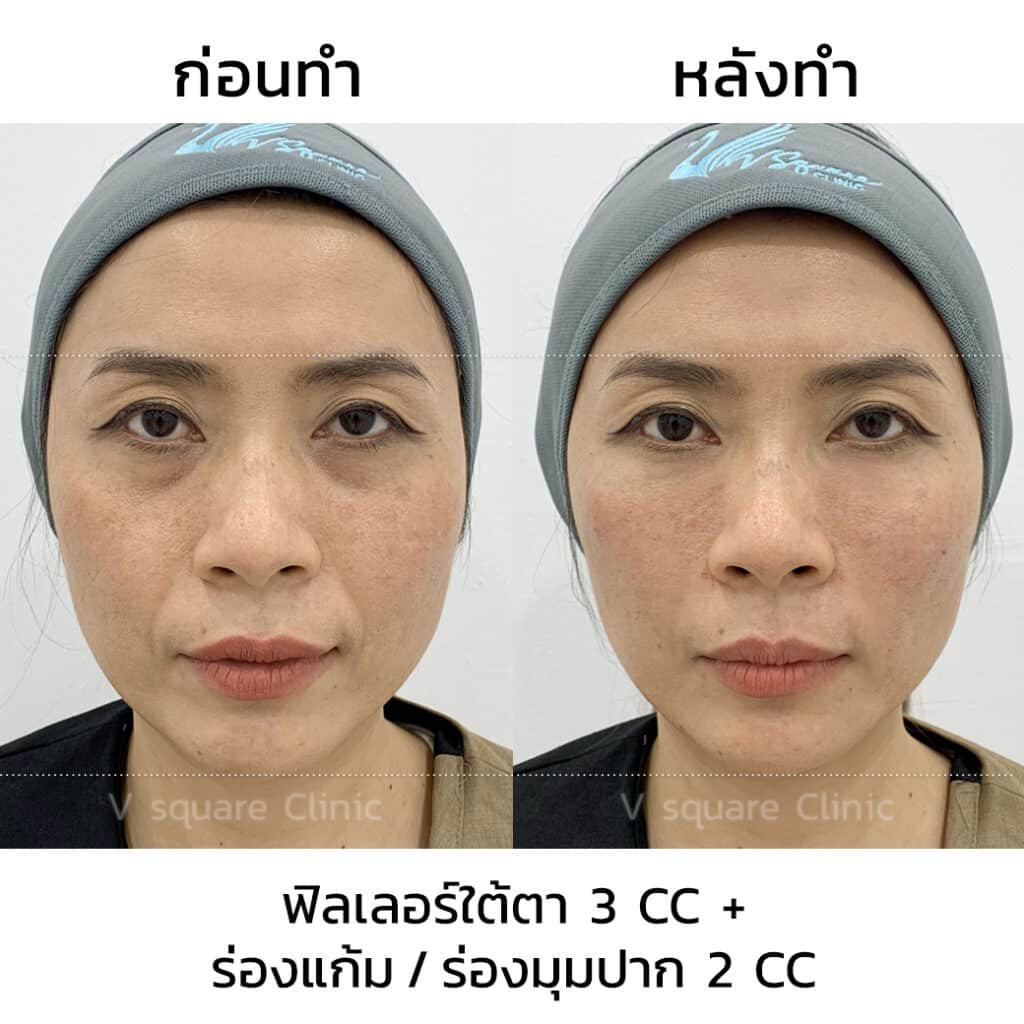 รีวิวฉีดฟิลเลอร์ร่องแก้ม