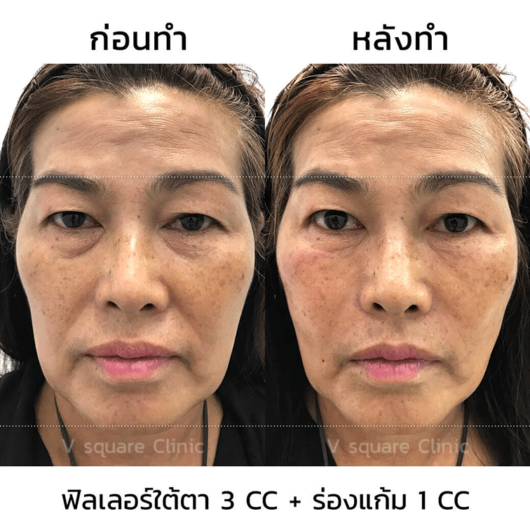 รีวิวฉีดฟิลเลอร์ร่องแก้ม