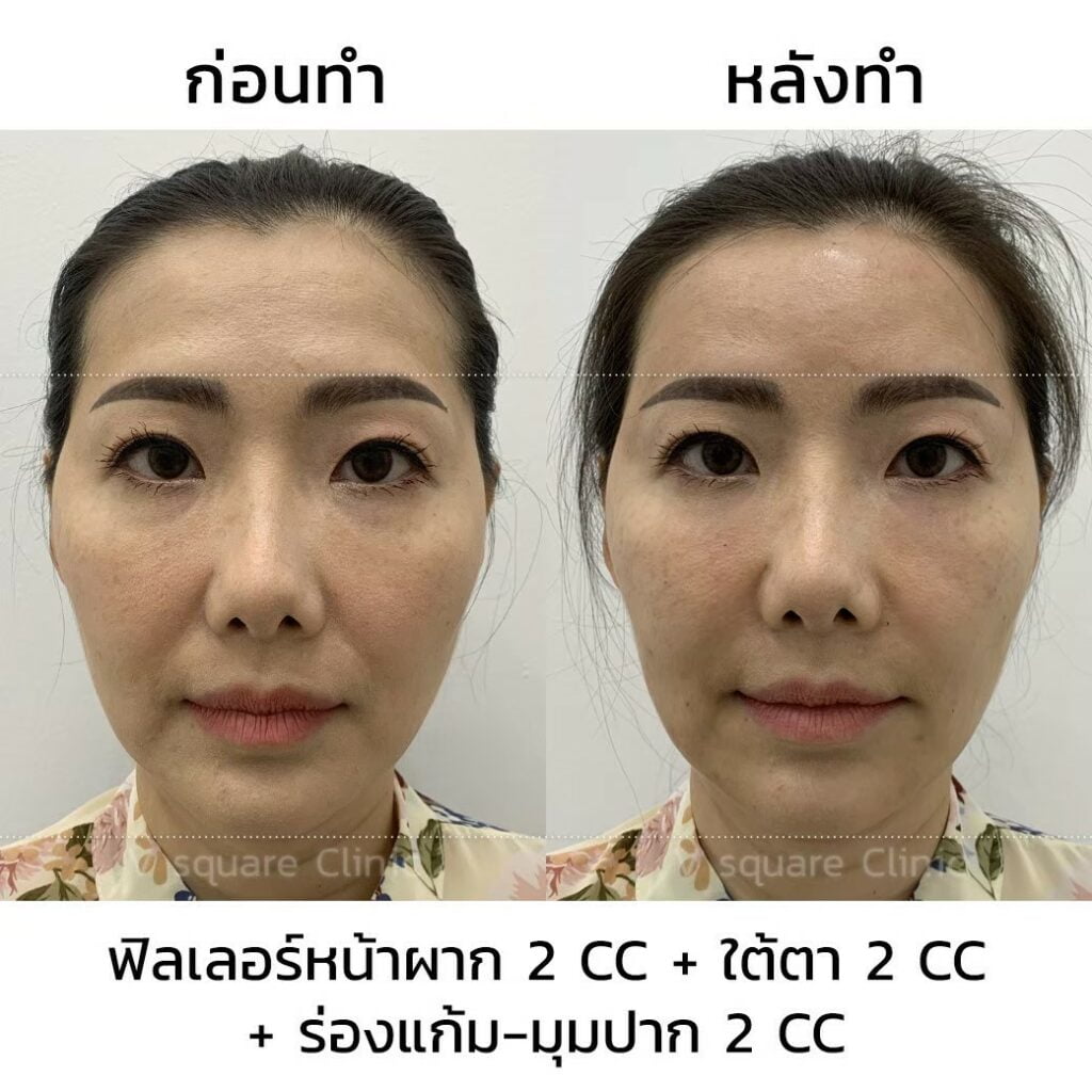 รีวิวฉีดฟิลเลอร์หน้าผาก