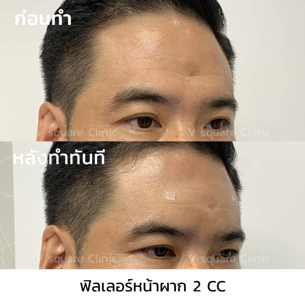 รีวิวฉีดฟิลเลอร์หน้าผาก(3)