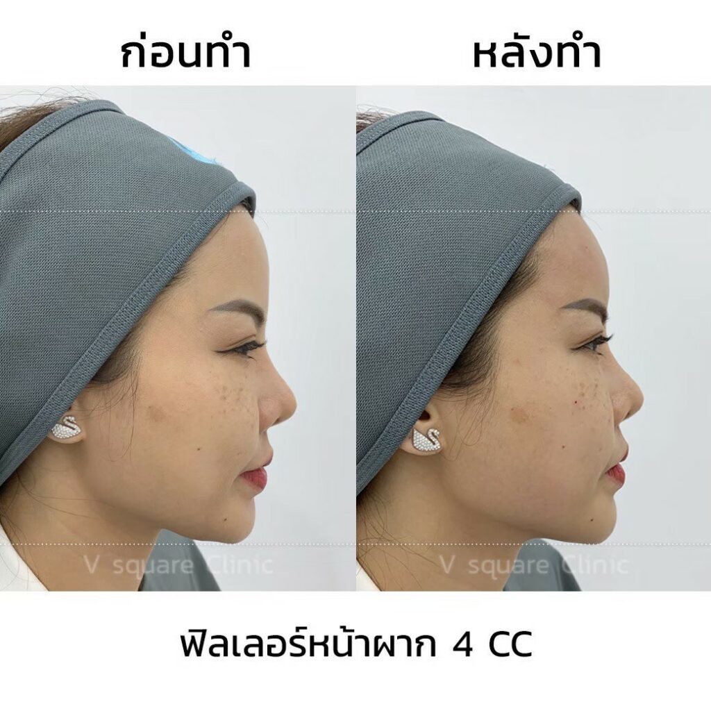 รีวิวฉีดฟิลเลอร์หน้าผาก(4)