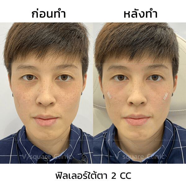 รีวิวฉีดฟิลเลอร์ใต้ตา