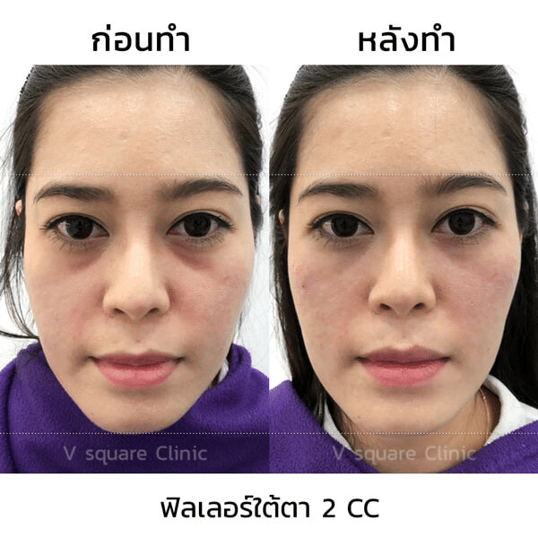 รีวิวฉีดฟิลเลอร์ใต้ตา(1)