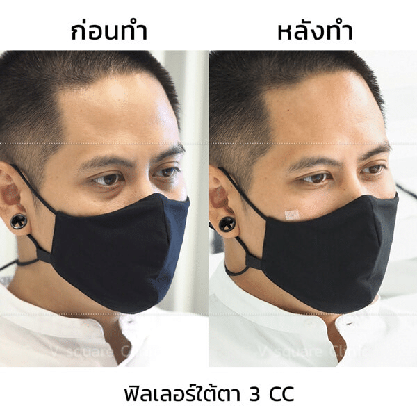 รีวิวฉีดฟิลเลอร์ใต้ตา(2)