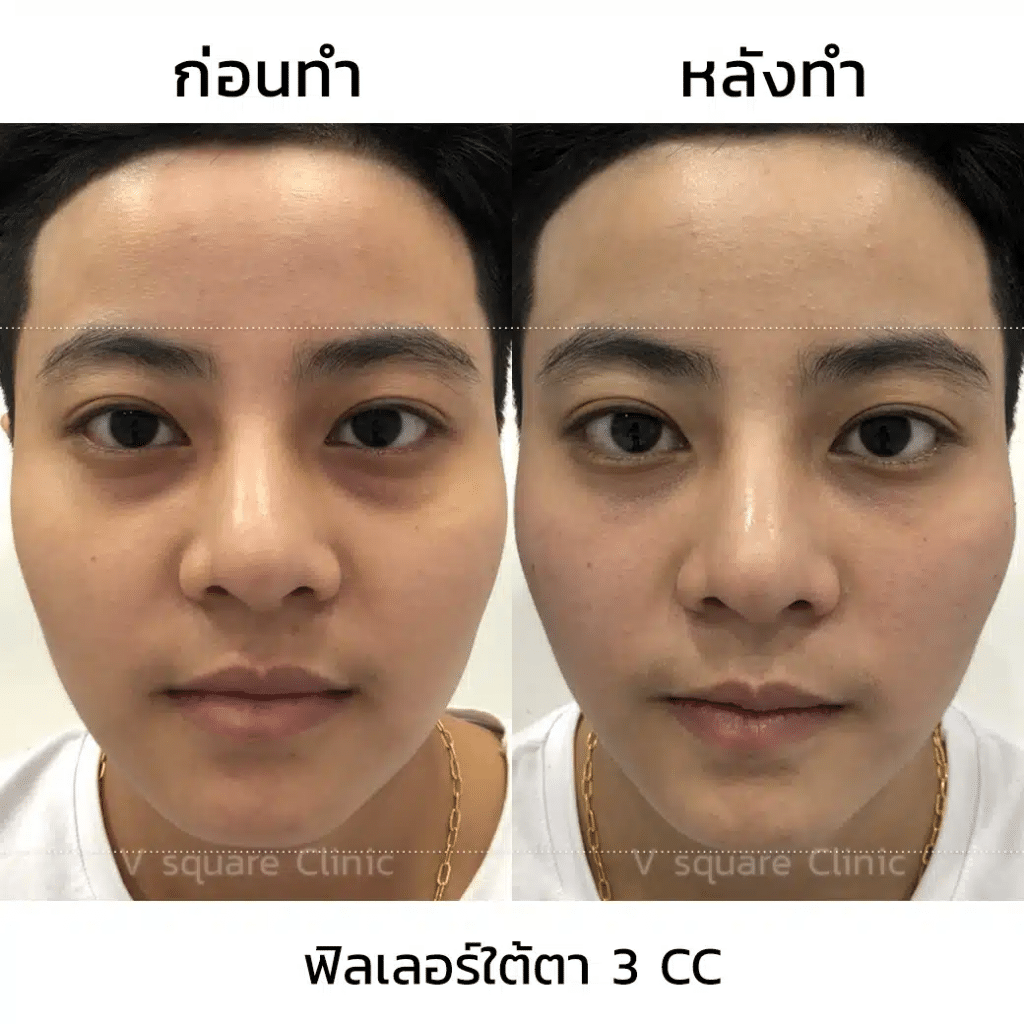 รีวิวฉีดฟิลเลอร์ใต้ตา(5)