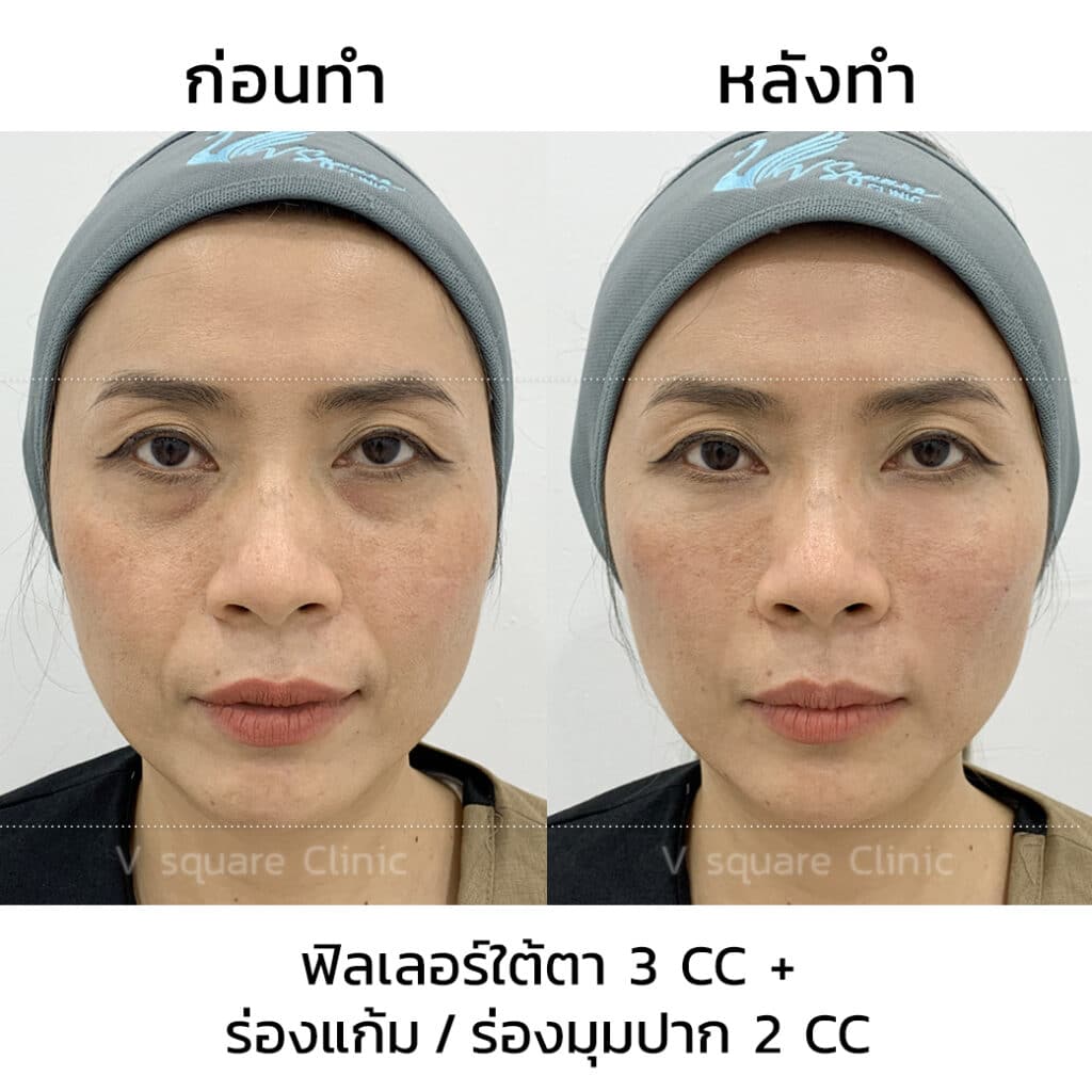 รีวิวฉีดฟิลเลอร์ใต้ตาที่ V Square Clinic