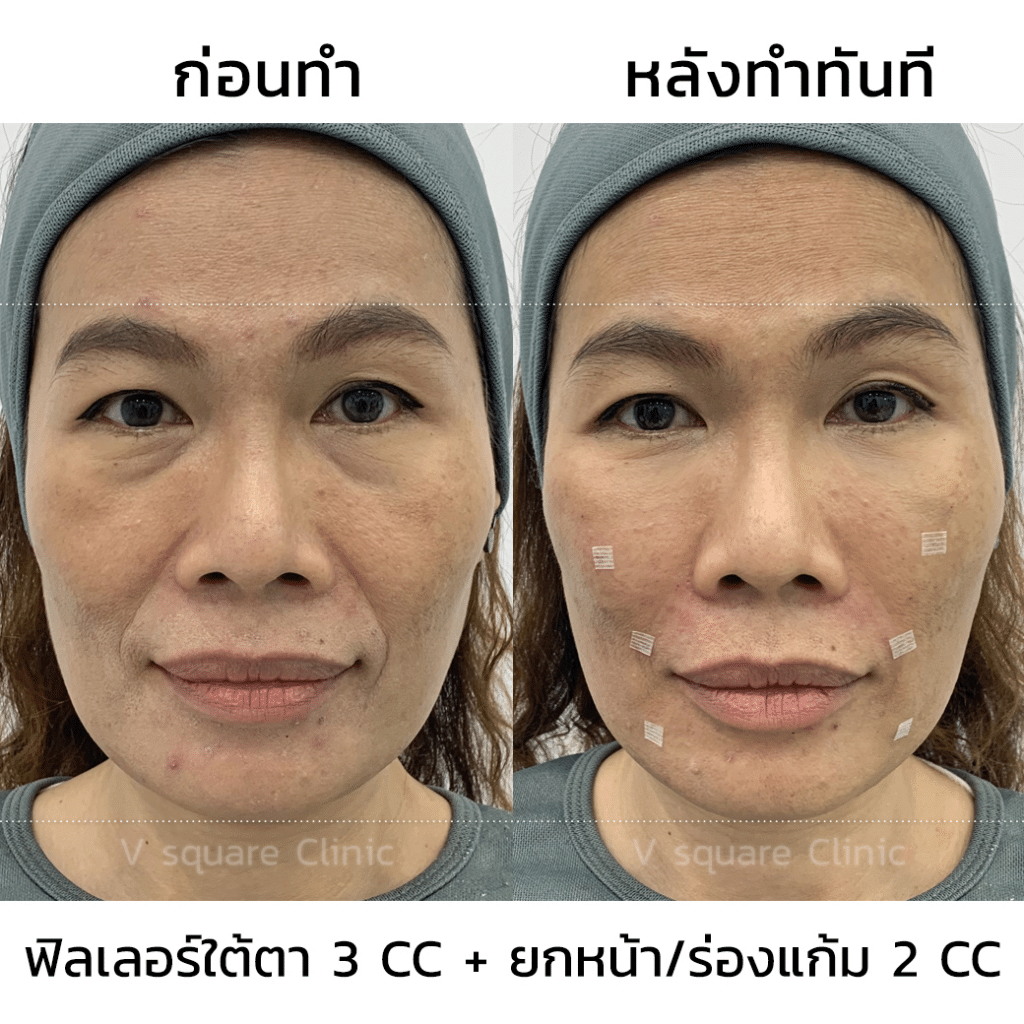 รีวิวฉีดฟิลเลอร์ใต้ตาที่ V Square Clinic