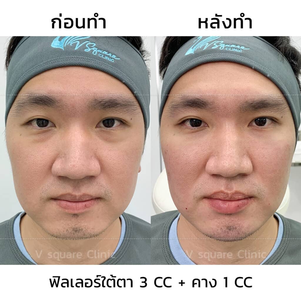 รีวิวฉีดฟิลเลอร์ใต้ตาที่ V Square Clinic(10)