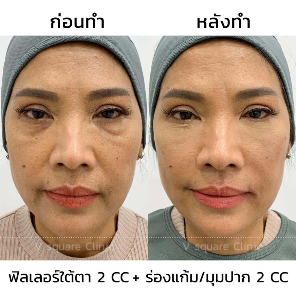 รีวิวฉีดฟิลเลอร์ใต้ตาที่ V Square Clinic(11)