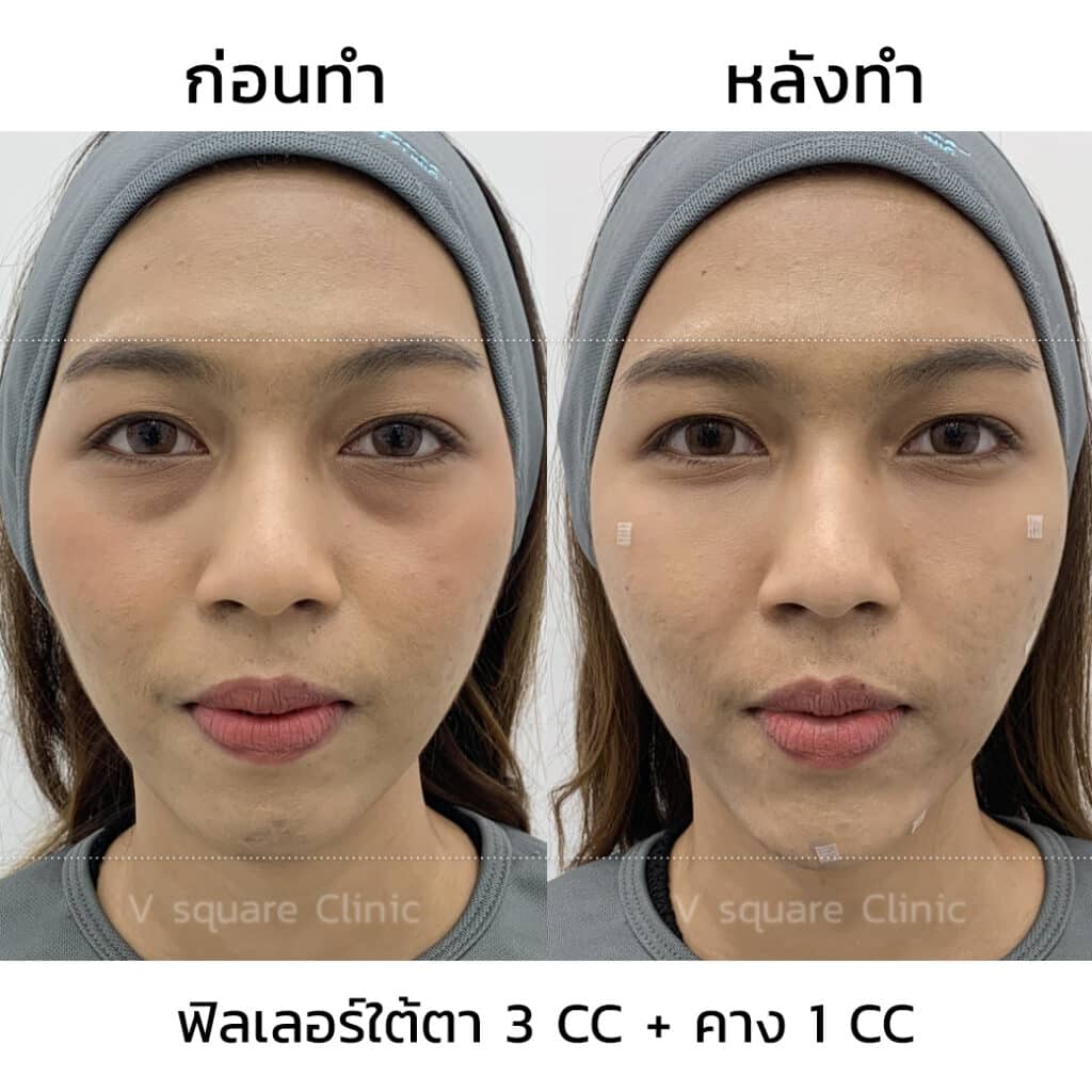 รีวิวฉีดฟิลเลอร์ใต้ตาที่ V Square Clinic(2)