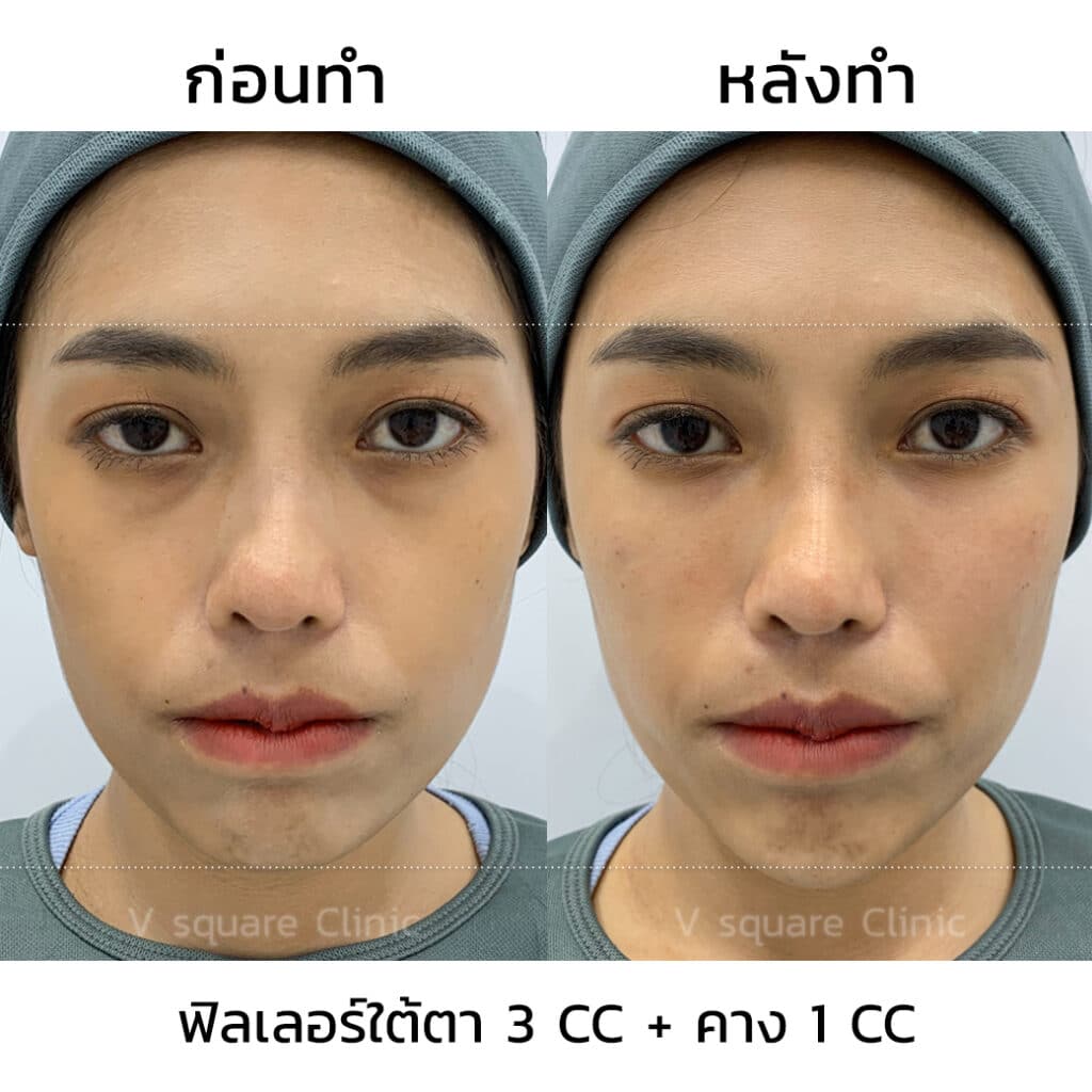 รีวิวฉีดฟิลเลอร์ใต้ตาที่ V Square Clinic(3)