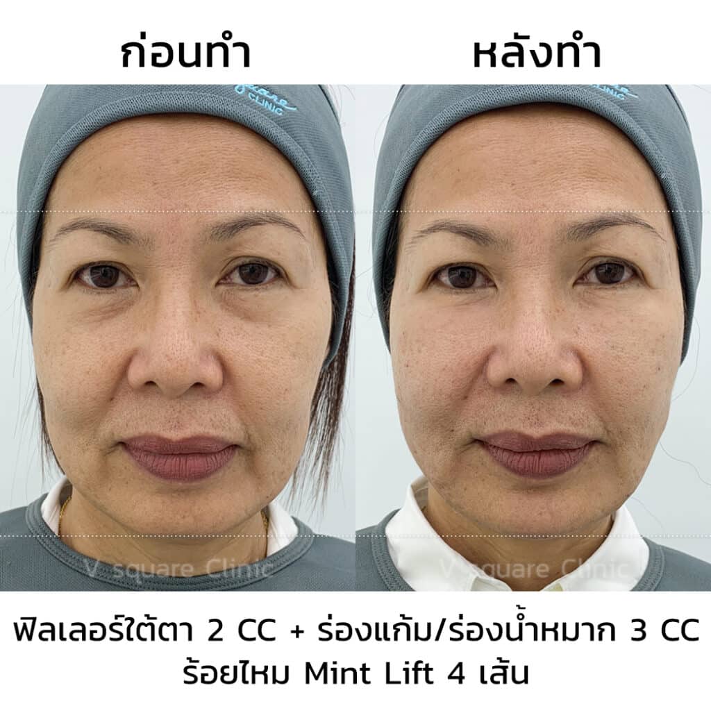 รีวิวฉีดฟิลเลอร์ใต้ตาที่ V Square Clinic(4)