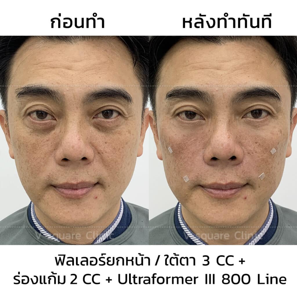 รีวิวฉีดฟิลเลอร์ใต้ตาที่ V Square Clinic(5)