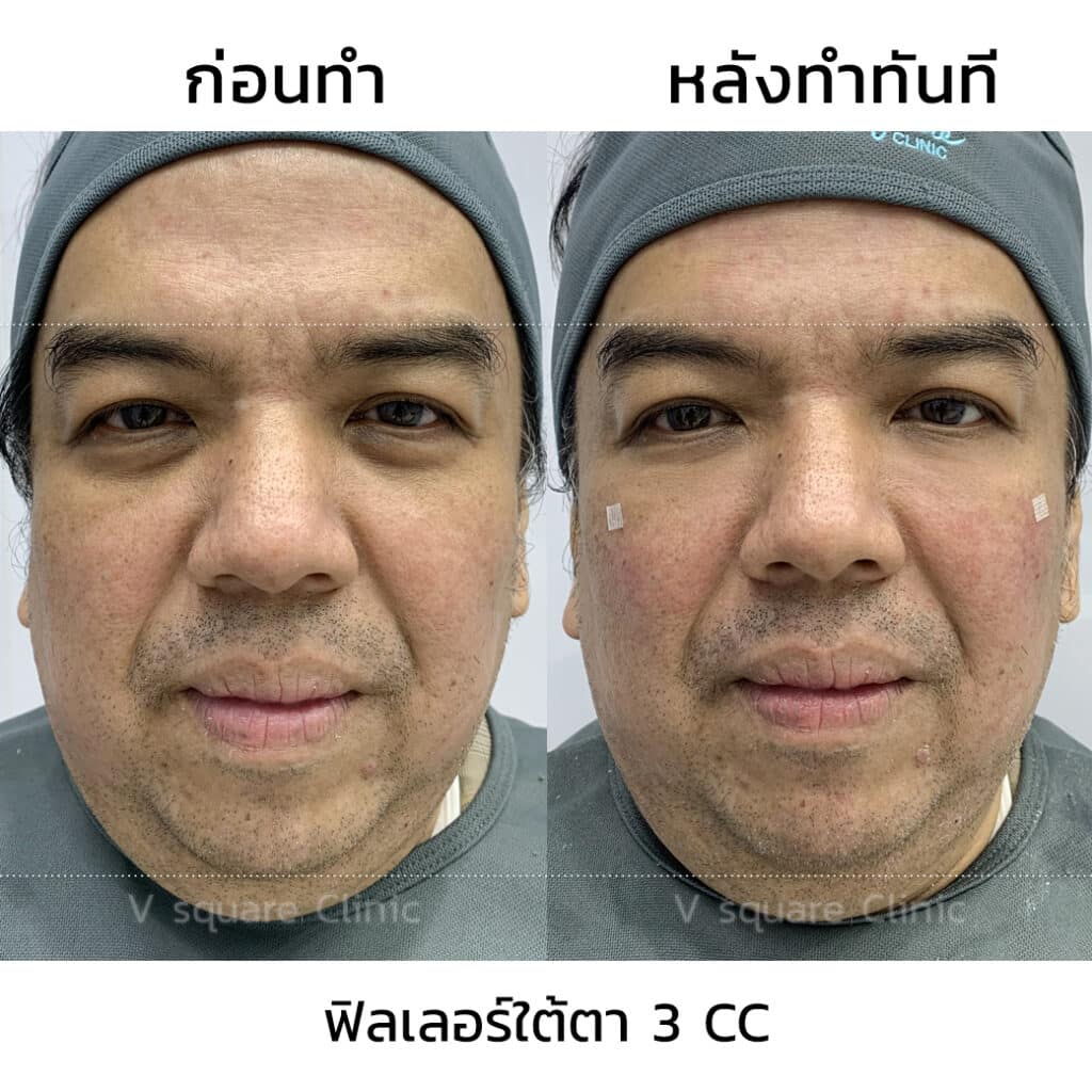 รีวิวฉีดฟิลเลอร์ใต้ตาที่ V Square Clinic(6)