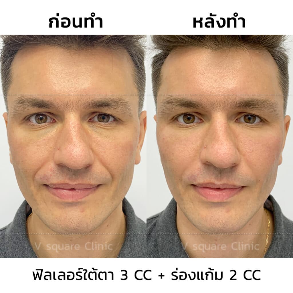 รีวิวฉีดฟิลเลอร์ใต้ตาที่ V Square Clinic(7)