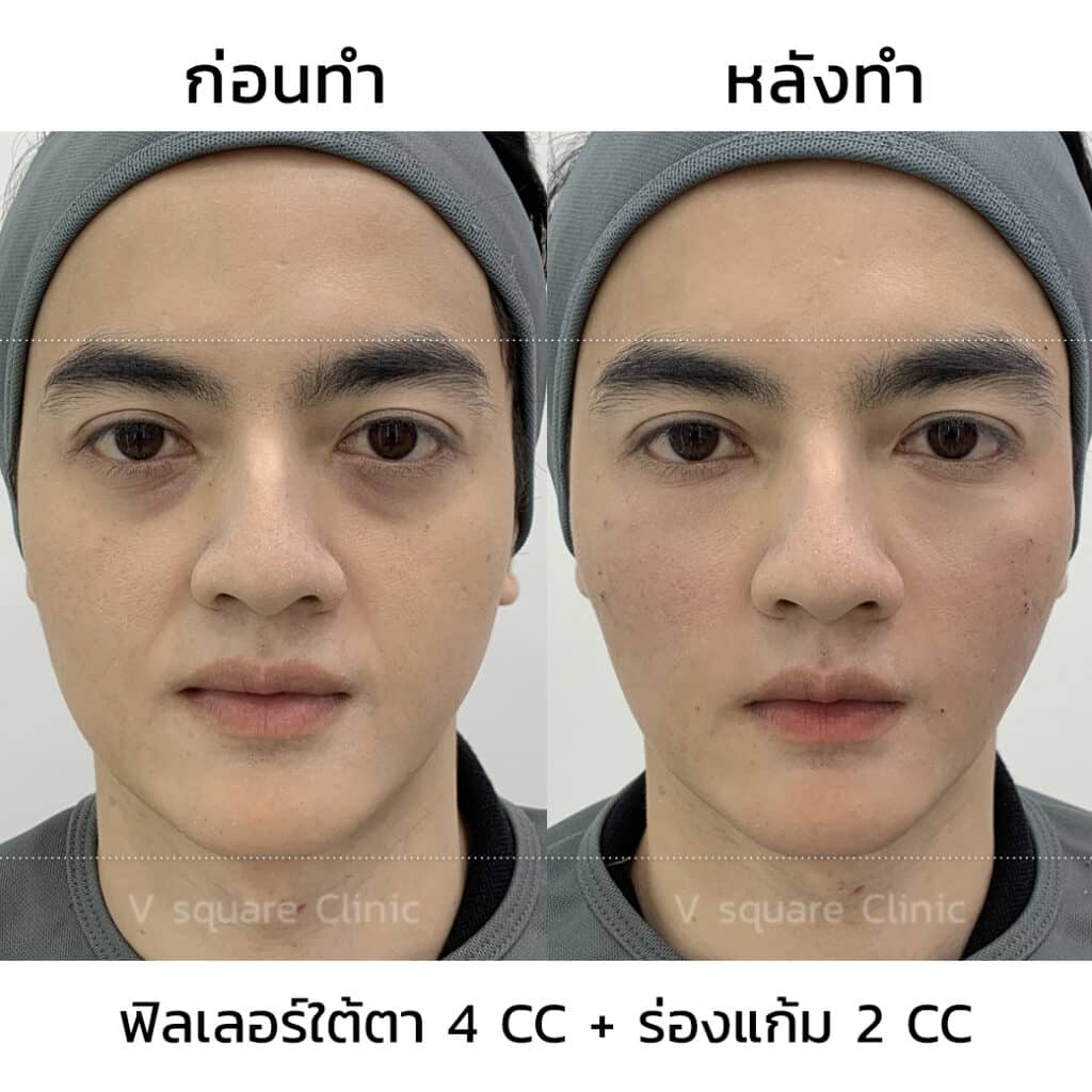 รีวิวฉีดฟิลเลอร์ใต้ตาที่ V Square Clinic(8)