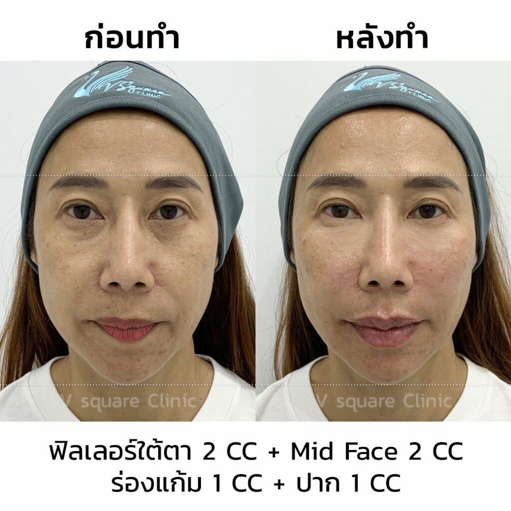 รีวิวฉีดฟิลเลอร์ใต้ตาที่ V Square Clinic(9)