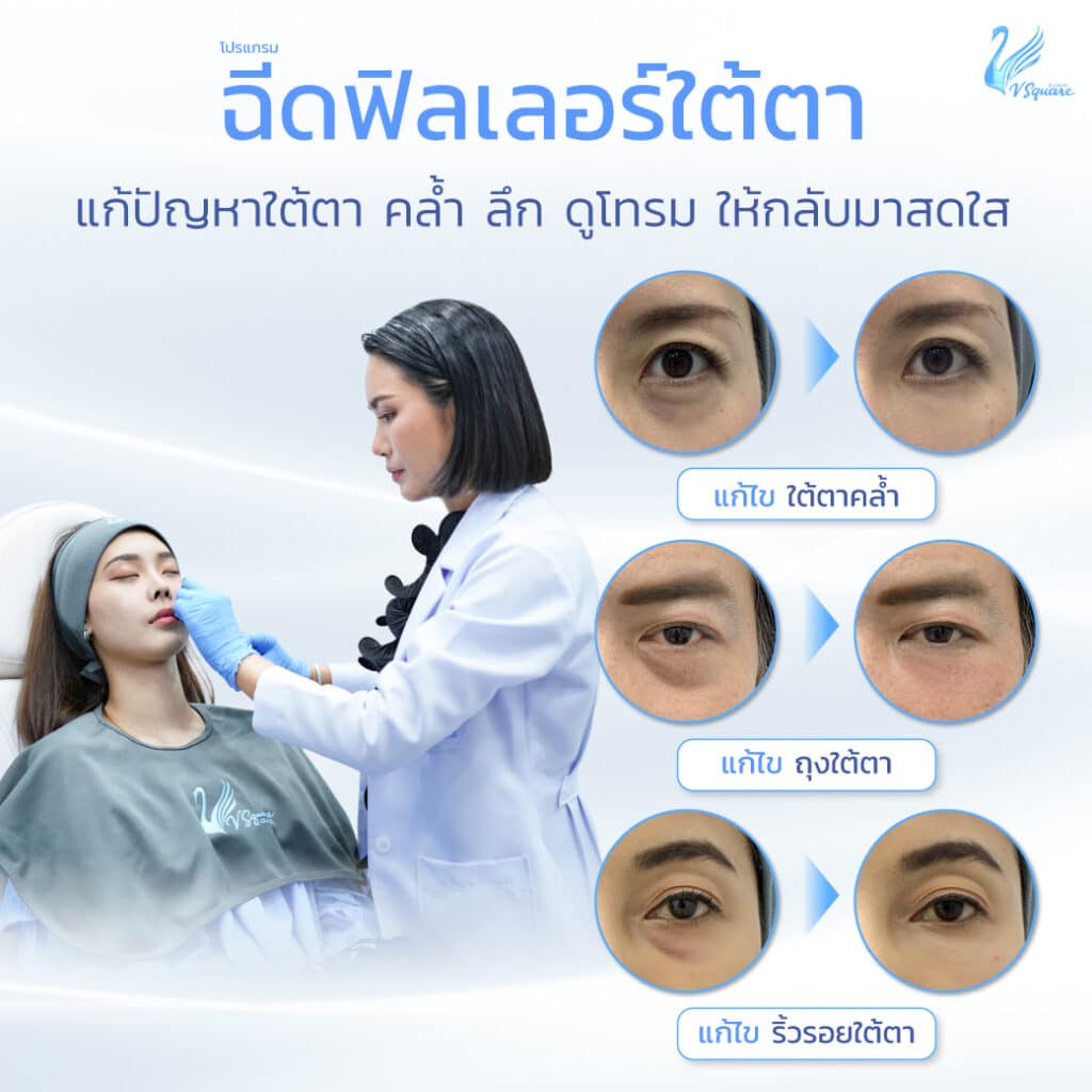 ฉีดไขมันใต้ตา VS ฉีดฟิลเลอร์ใต้ตา โดย หมอแนน และคุณฟ้า