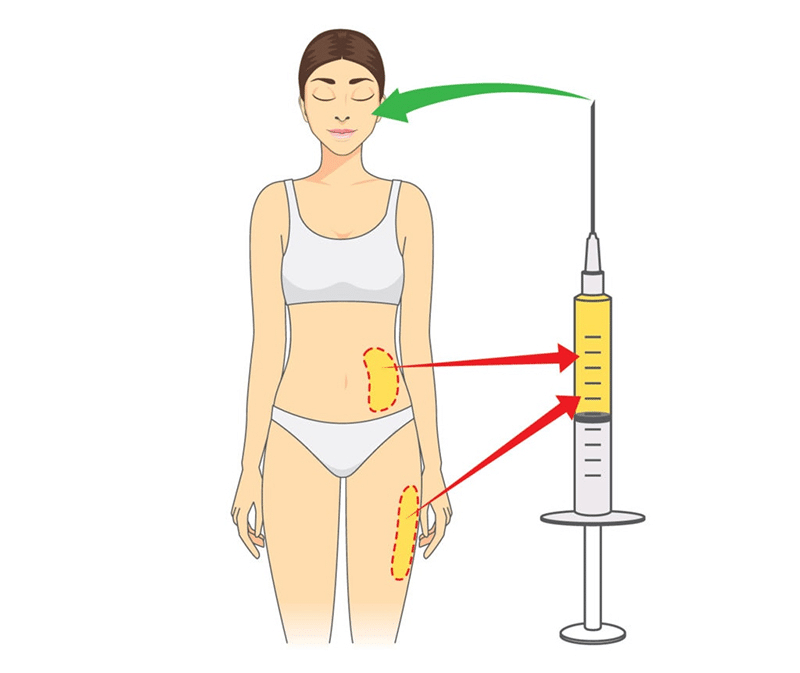 ฉีดไขมันใต้ตา คือ