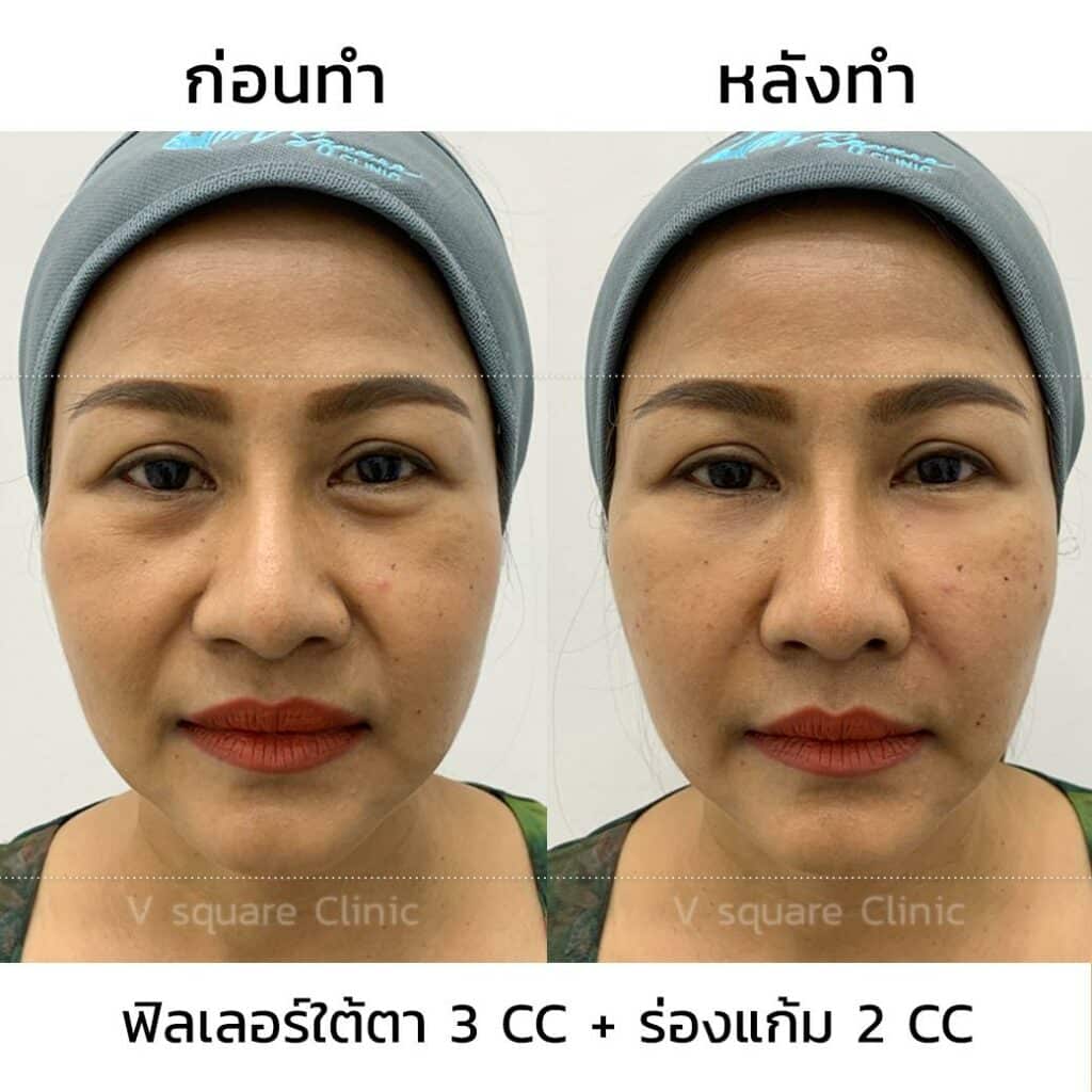 รีวิวฉีดฟิลเลอร์ใต้ตา