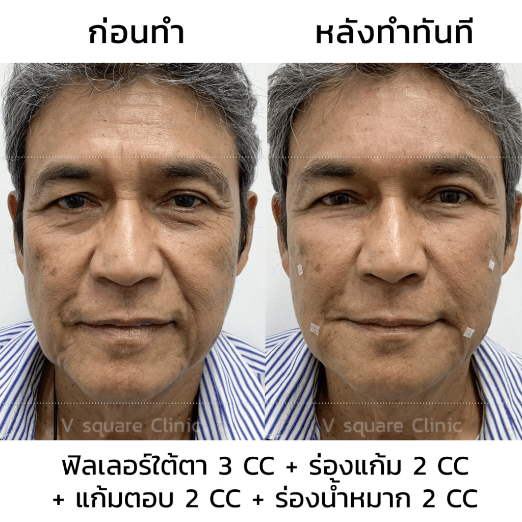 รีวิวฉีดฟิลเลอร์ใต้ตา